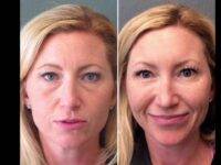 Correct Wrinkles With Juvederm