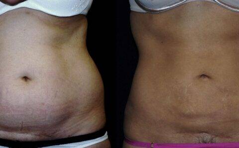 Is liposuction the right choice for you?
